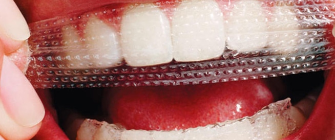 لصقات تبييض الأسنان: أهم الفوائد والمخاطر - ويب طب