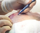 التعليمات الواجب مراعاتها قبل وبعد إجراء عملية زراعة الشعر