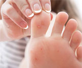 فقاعات القدم: أسبابها وطرق علاجها