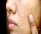 أسباب وعلاج البثور السوداء في الوجه