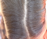 أسباب قشرة الشعر في الشتاء وطرق طبيعية لعلاجها