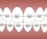 أنواع تقويم الأسنان ومعلومات أخرى هامة 