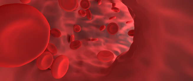 تمدد الأوعية الدموية (أم الدم): دليلك الشامل