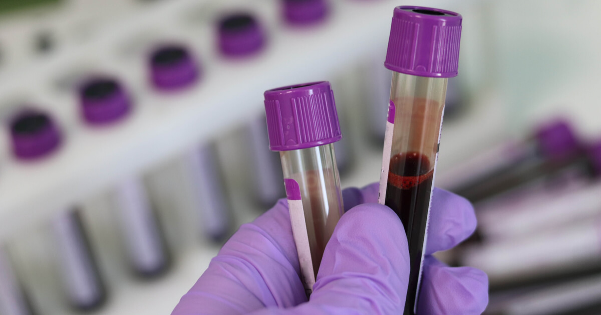 تحليل فقر الدم أهم الفحوصات اللازمة للتشخيص ويب طب