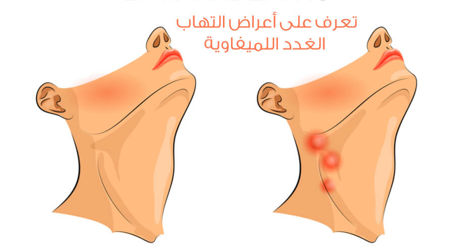 الليمفاوية تضخم الغدد تورم العقد