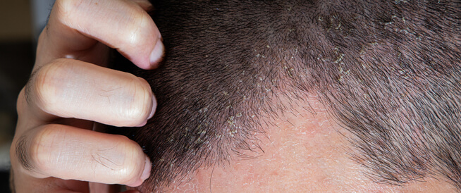 التهاب فروة الرأس: أسباب عديدة وطرق العلاج