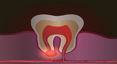 علاج الخراج الأسنان