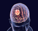 أعراض سرطان الدماغ: تعرف عليها