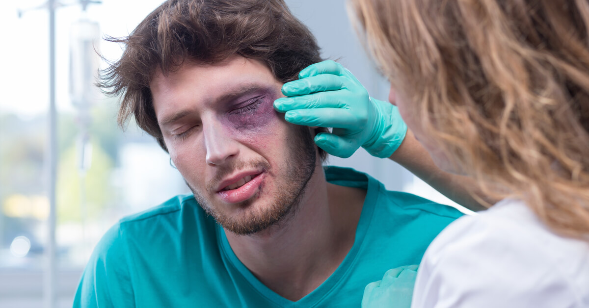 علاج كدمات العين طب الويب