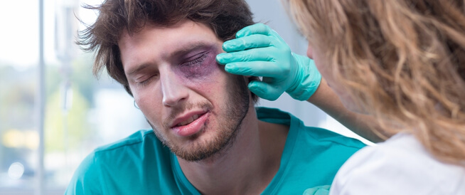  علاج كدمات العين