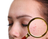حبوب تحت الجلد في الوجه والجسم: أهم المعلومات