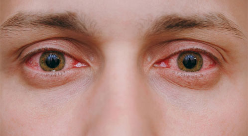 علاج احمرار العين بطرق مختلفة ويب طب