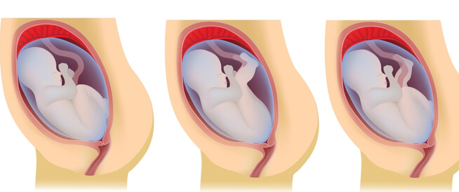 وضعية الجنين المقعدي: أهم المعلومات