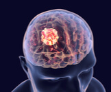 أعراض الورم في المخ: تعرف عليها