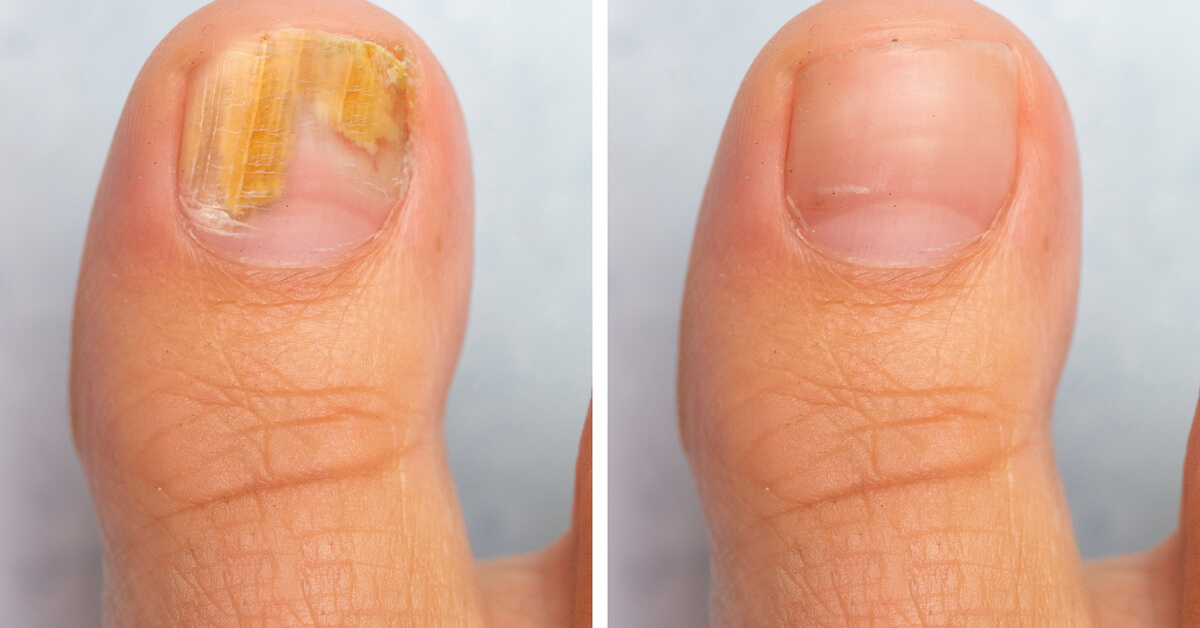 Fong de les ungles del peu: conegui les seves causes i mètodes de tractament - WebTeb