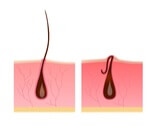 كيفية إزالة الشعر تحت الجلد