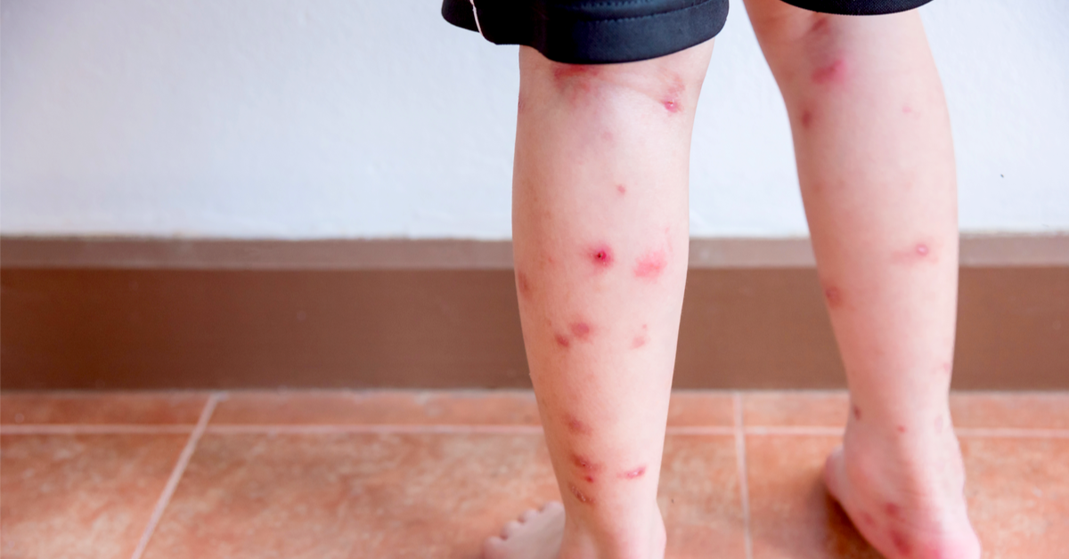 أسباب ظهور بقع حمراء على الجلد في الساق ويب طب