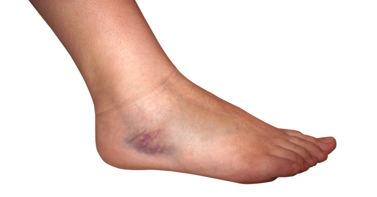 كدمات القدم ماذا يجب أن تعرف عنها ويب طب