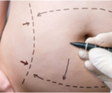 عملية شد البطن: دليلك الشامل - ويب طب