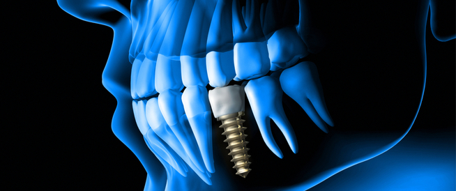 أضرار زراعة الأسنان: هل تفوق فوائده؟ - ويب طب
