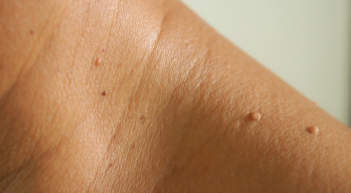 هل يمكن علاج الزوائد الجلدية وما هي أفضل الطرق لعلاجها