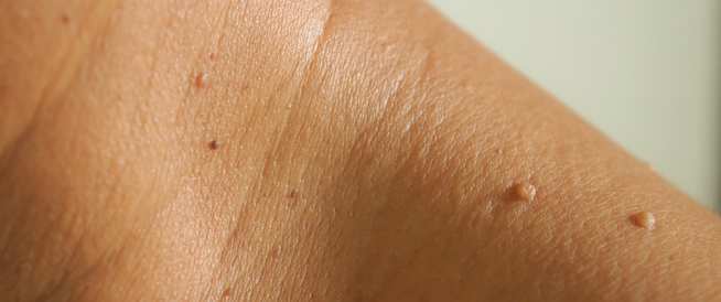 كيف يمكن علاج الزوائد الجلدية؟