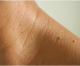 كيف يمكن علاج الزوائد الجلدية؟