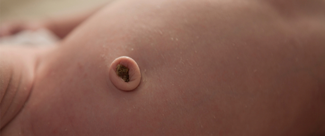 الورم الحبيبي في سرة الرضيع ما هو ويب طب