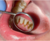 مضاعفات تسوس الأسنان: تعرف عليها