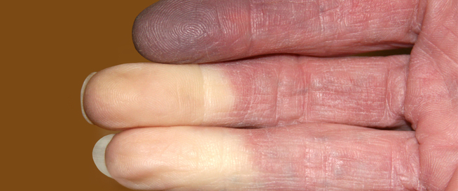 أسباب وعلاج احتباس الدم في الأصبع