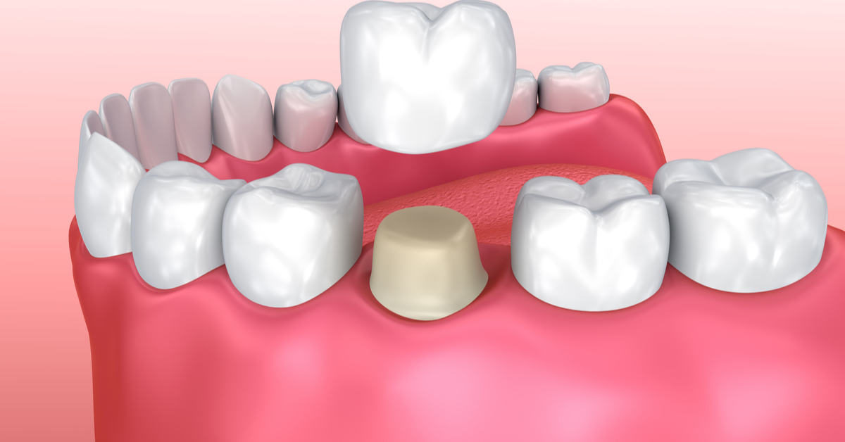 تلبيس الأسنان بعد سحب العصب أهم المعلومات ويب طب