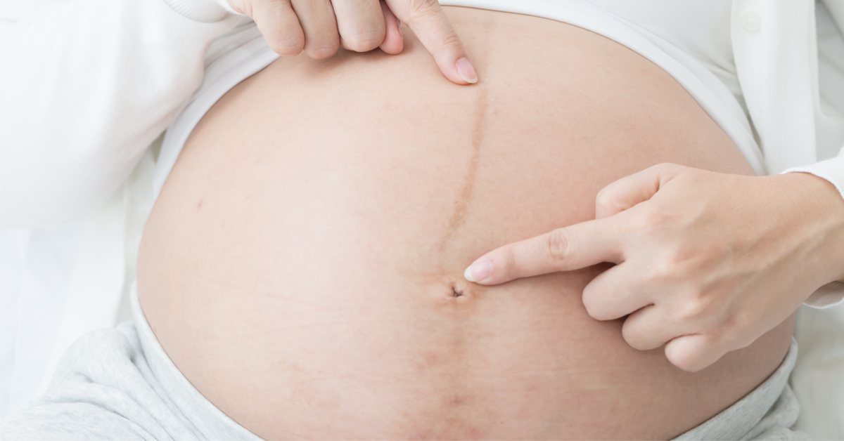 سبب ظهور خط أسود في بطن الحامل ويب طب