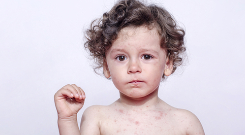 طرق علاج حساسية الجلد عند الأطفال