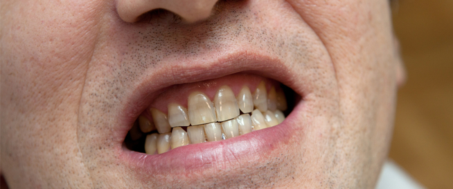 أسباب تغير لون الأسنان إلى الرمادي ويب طب