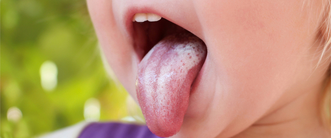 علاج فطريات اللسان عند الأطفال