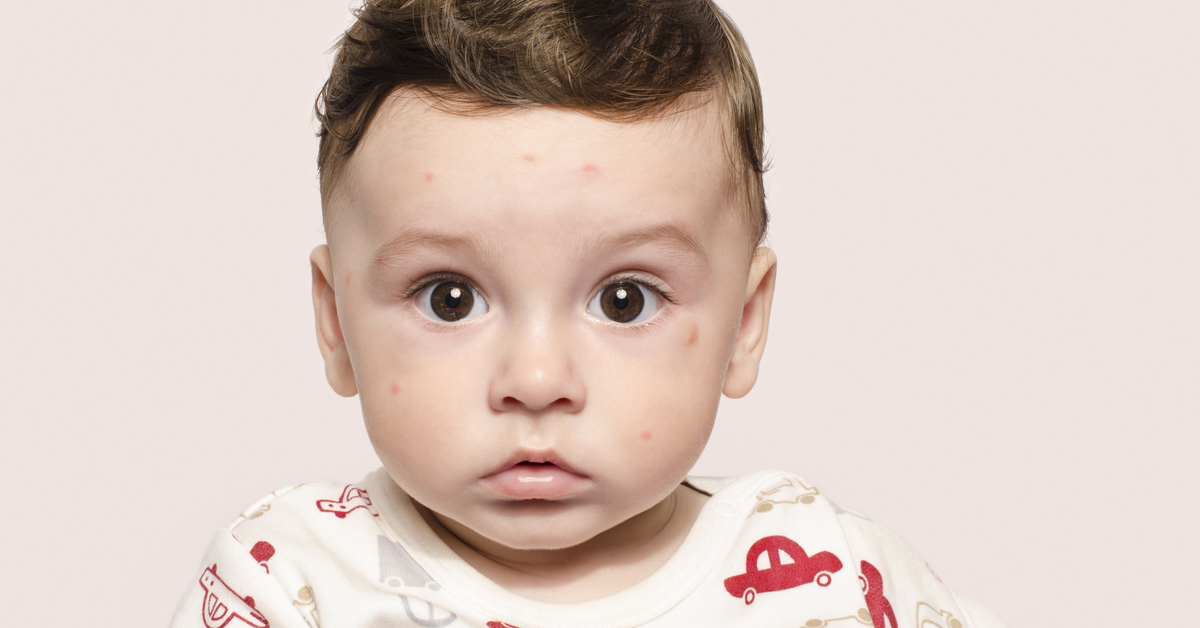 أسباب ظهور بقع بيضاء على الوجه للأطفال ويب طب
