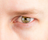 علاج ترهل الجفن العلوي للعين