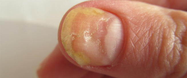 Causes of yellowing nails and how to treat them