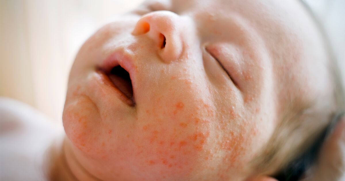 أسباب حساسية الجلد المفاجئة عند الأطفال وكيفية تجنبها