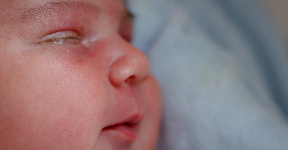 إفرازات العين عند الأطفال حديثي الولادة: دليلك الشامل
