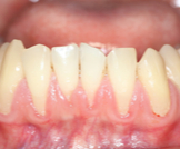 علاج تعري جذور الأسنان