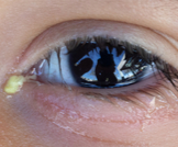 إفرازات العين البيضاء: كل ما يهمك أن  تعرفه عنها