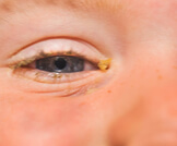 علاج إفرازات العين الصفراء عند الأطفال
