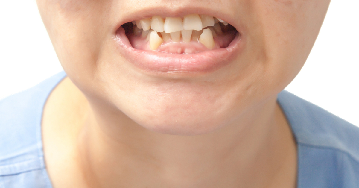 ازدحام الأسنان مشكلة صحية تداركها قبل أن تتفاقم ويب طب