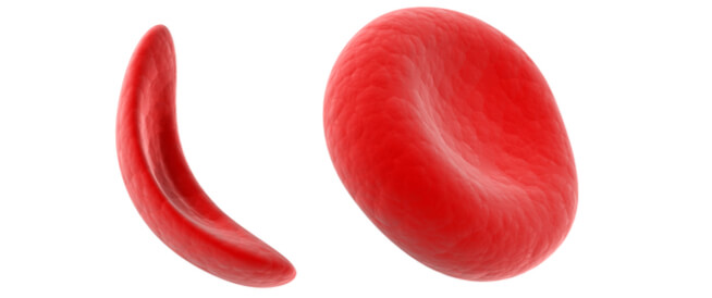 الانيميا المنجلية مرض فقر الدم