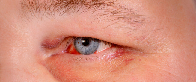 تعرف على أبرز المعلومات عن نزيف العين بسبب الضغط