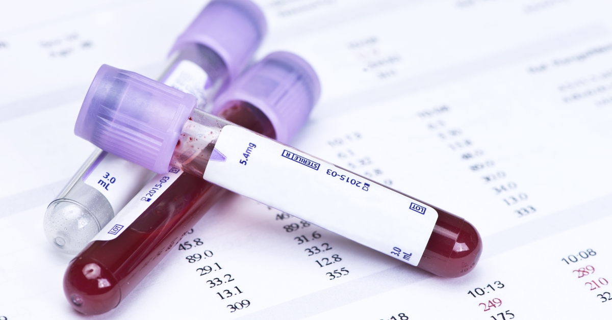 هل تحليل الدم الشامل يكشف الإيدز؟ - ويب طب
