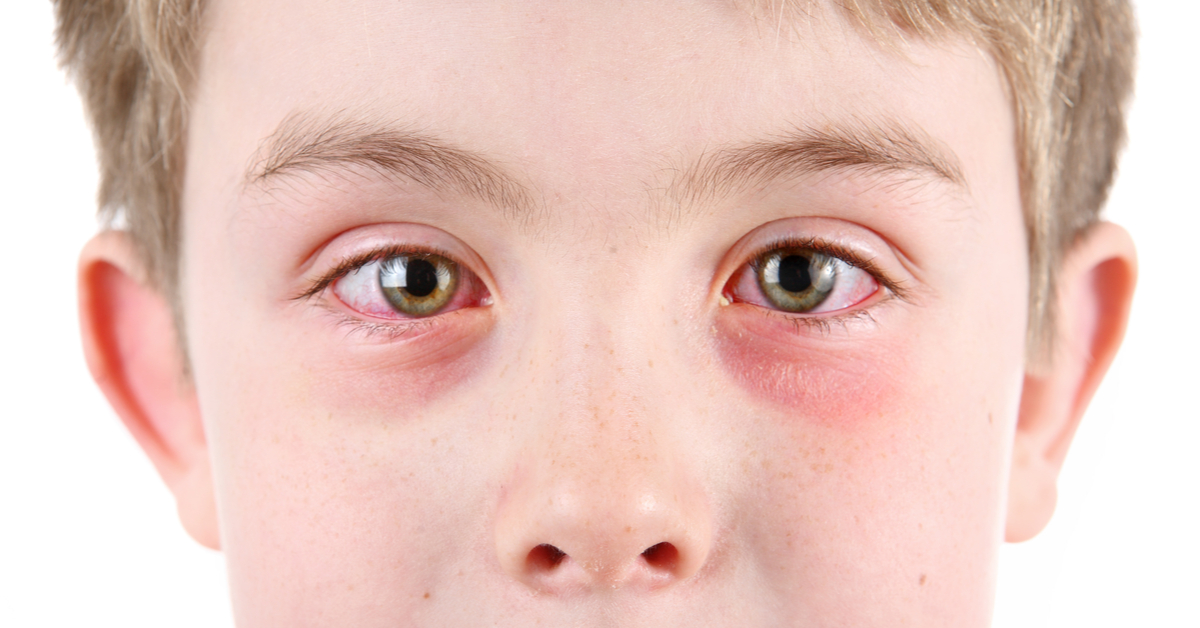 تعرف على حساسية العين عند الأطفال - ويب طب