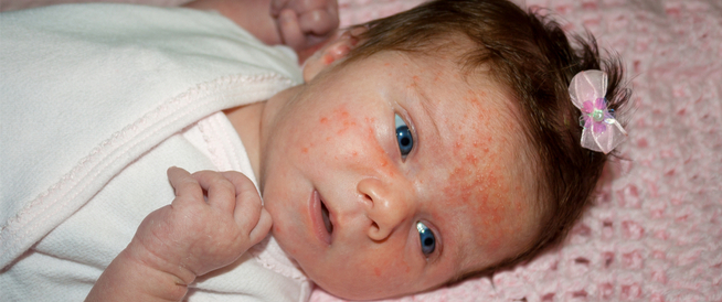 تعرف على علاج أكزيما الرضع