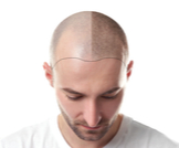الممنوعات بعد زراعة الشعر